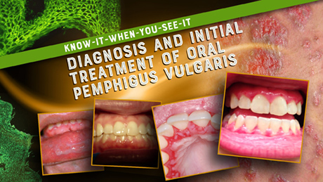 Diagnosis and Initial Treatment of Oral Pemphigus Vulgaris